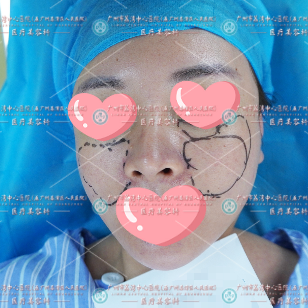 2次取奥失败痛不欲生，来我院成功取出修复，术中取出一团团豆腐渣样材料