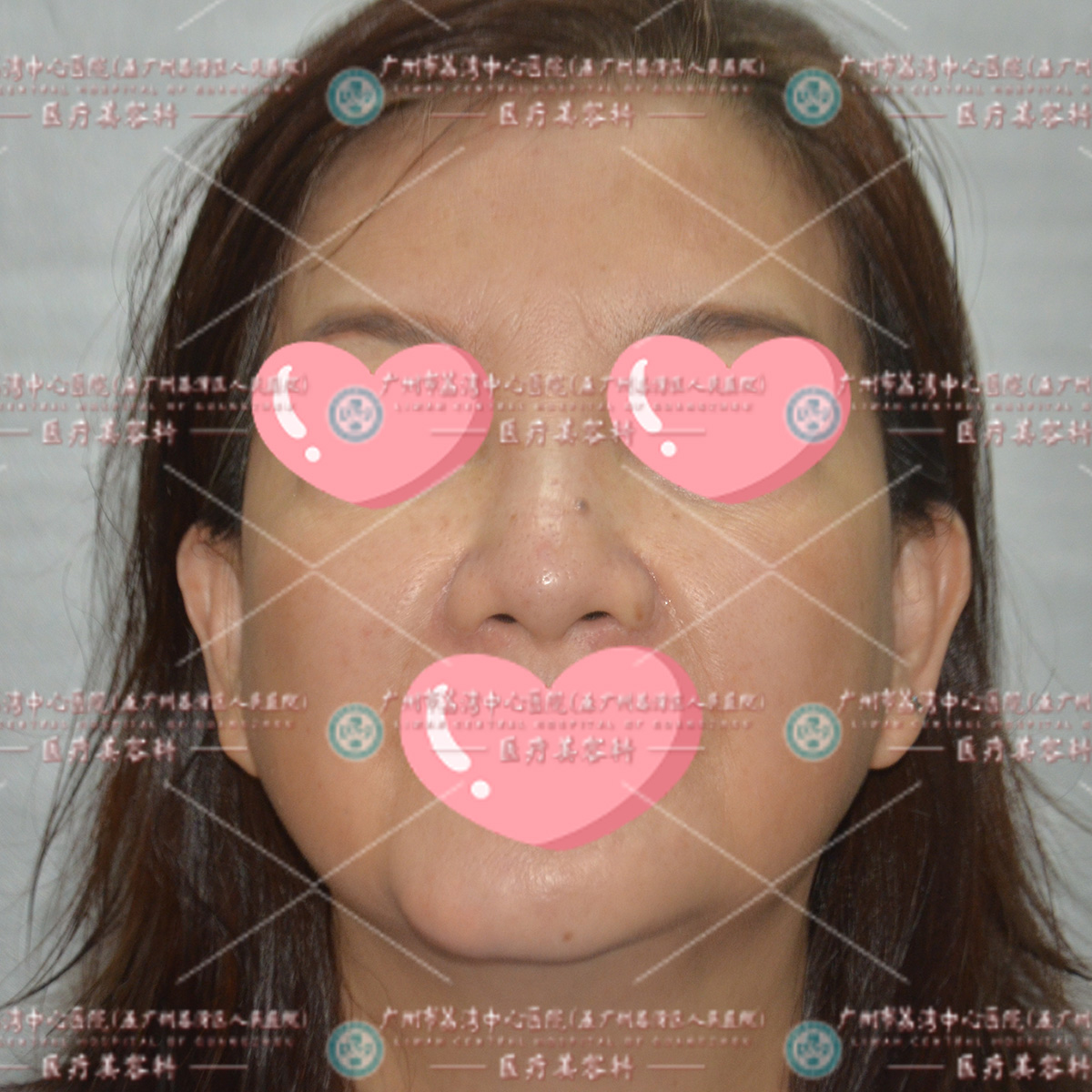 五旬女士的脸部肿胀之痛：注射填充后右脸肿胀、剧烈疼痛