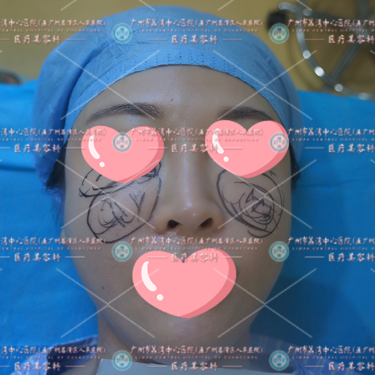 苹果肌填充肿胀凸起，逐渐压迫到眼球，术中取出大量腐蚀组织