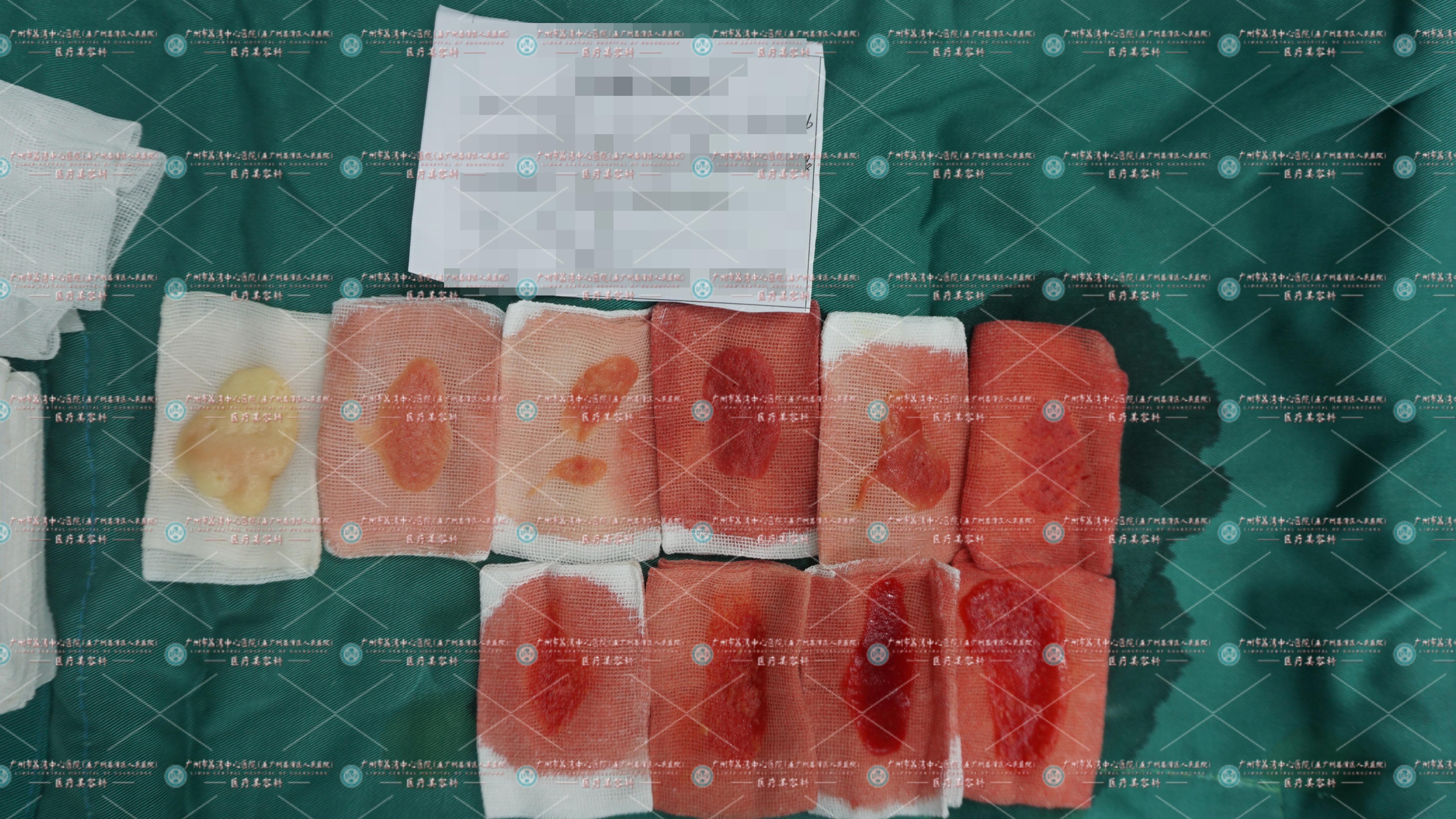 如何成功取出面部奥美定