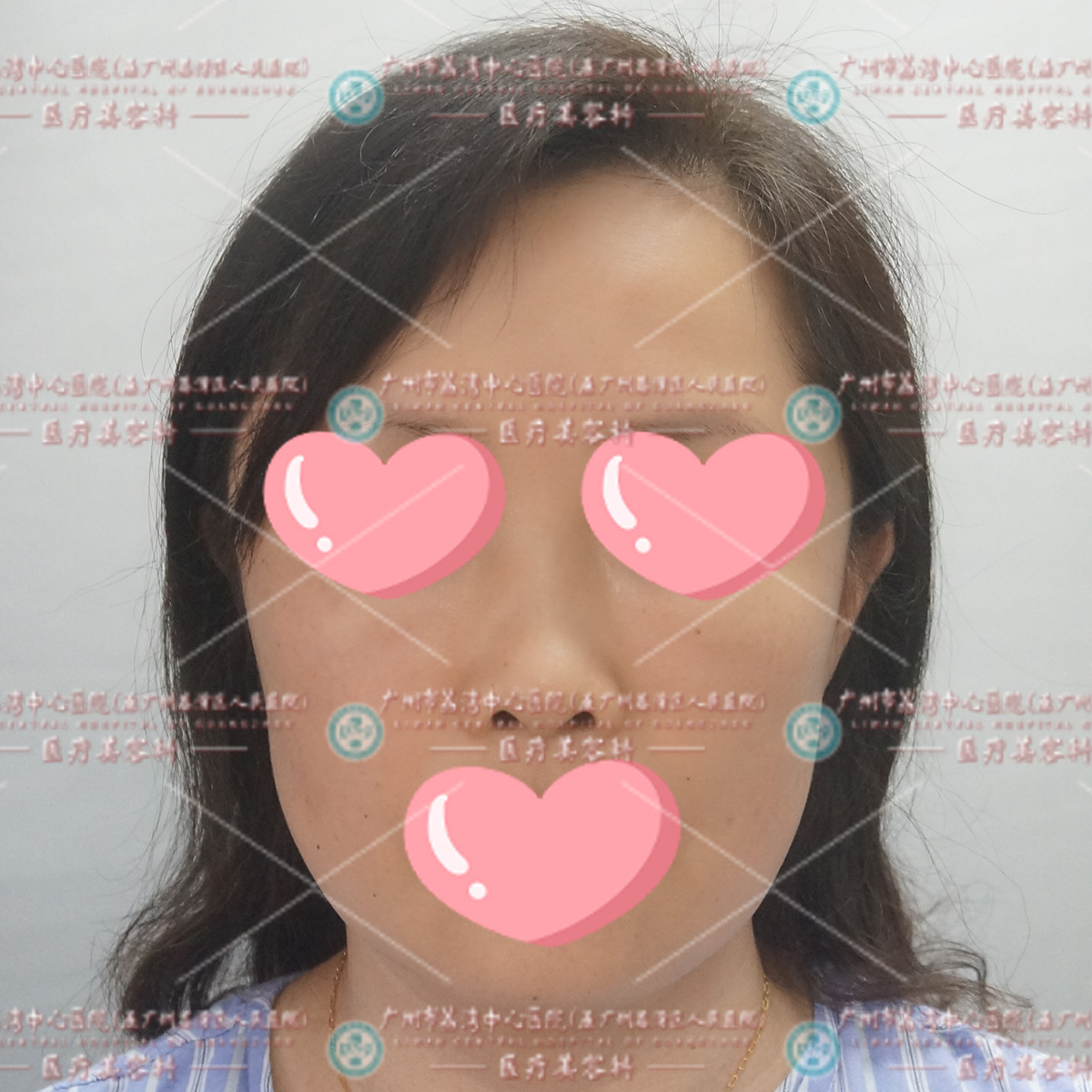 26岁女士打奥美定隆鼻，肿胀变形游离到面部，来取出增生组织