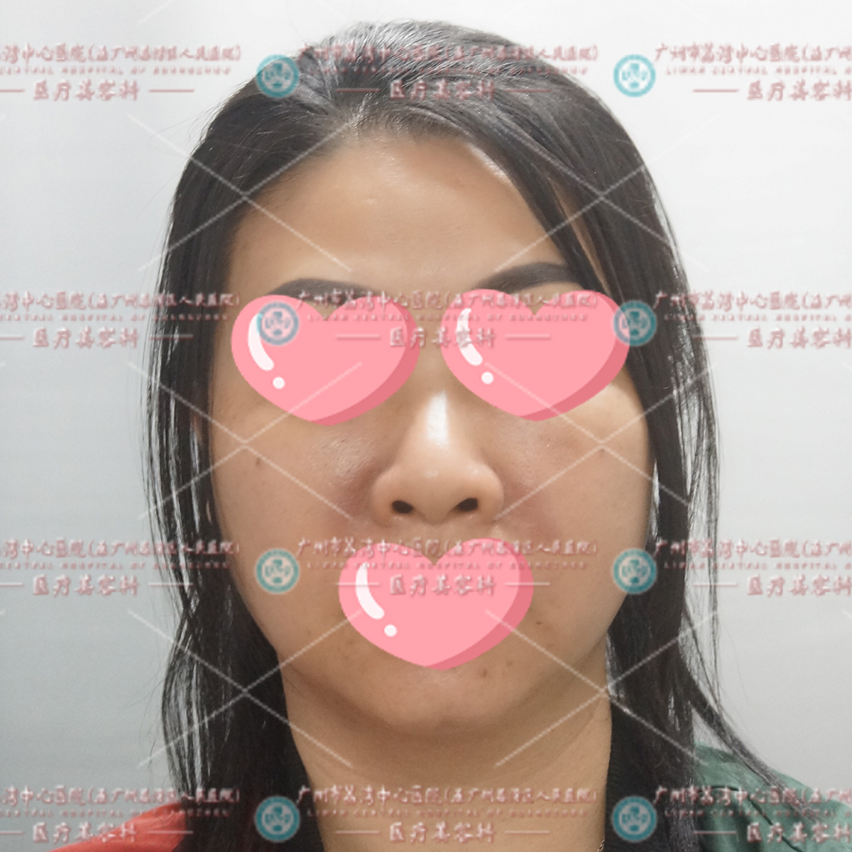 43岁女士注射除皱结果打到奥美定，疼痛变形还起硬块，来院做取出修复