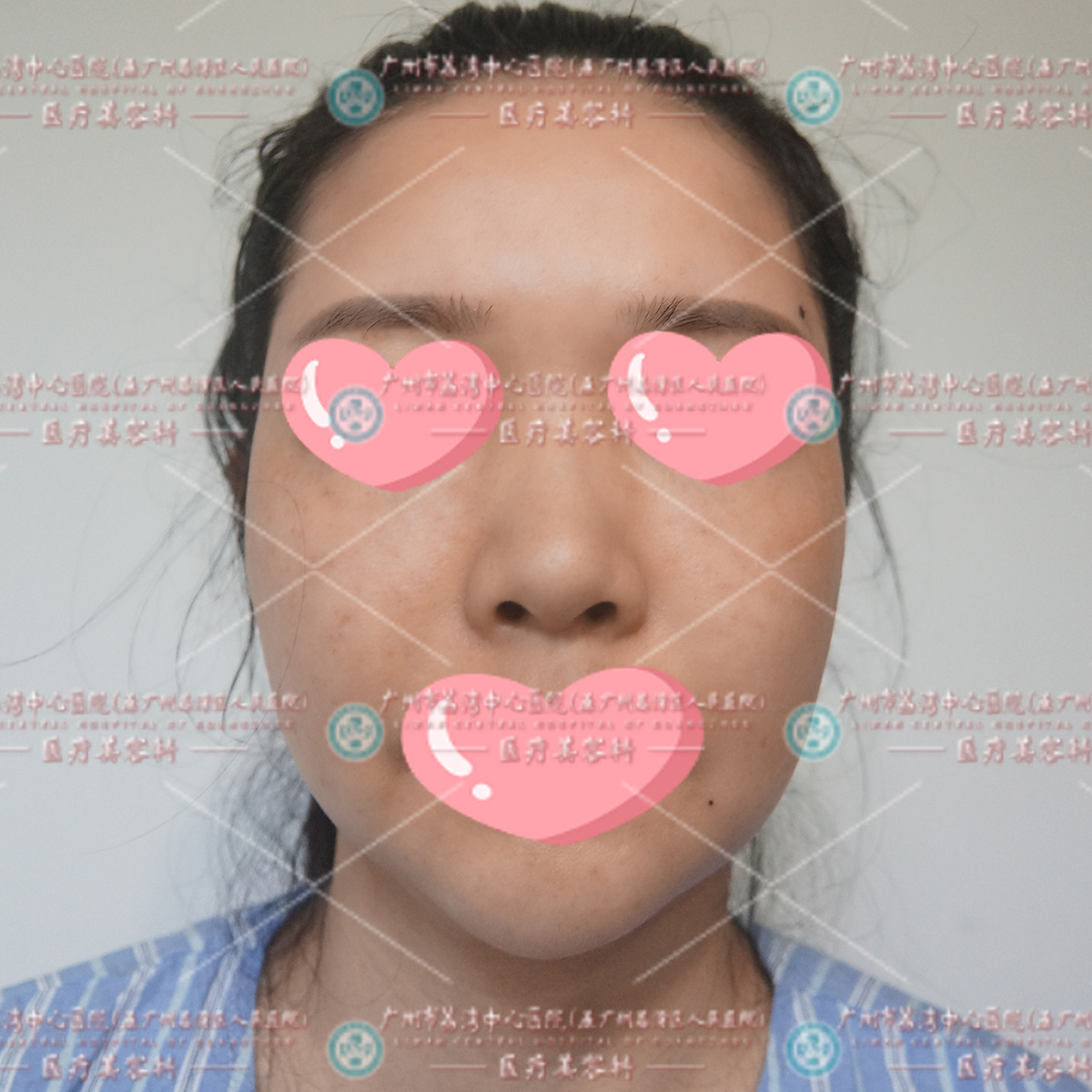 真实案例：小年轻在工作室打奥美定丰下巴，出现肿胀增生，找到我院做修复