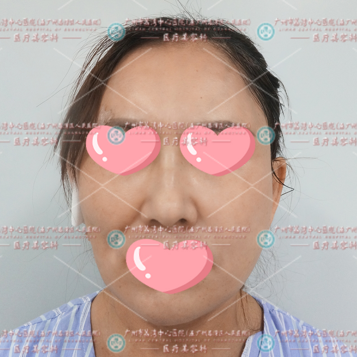 苹果肌注射奥美定僵硬不自然，轮廓变形难看，来院取出修复