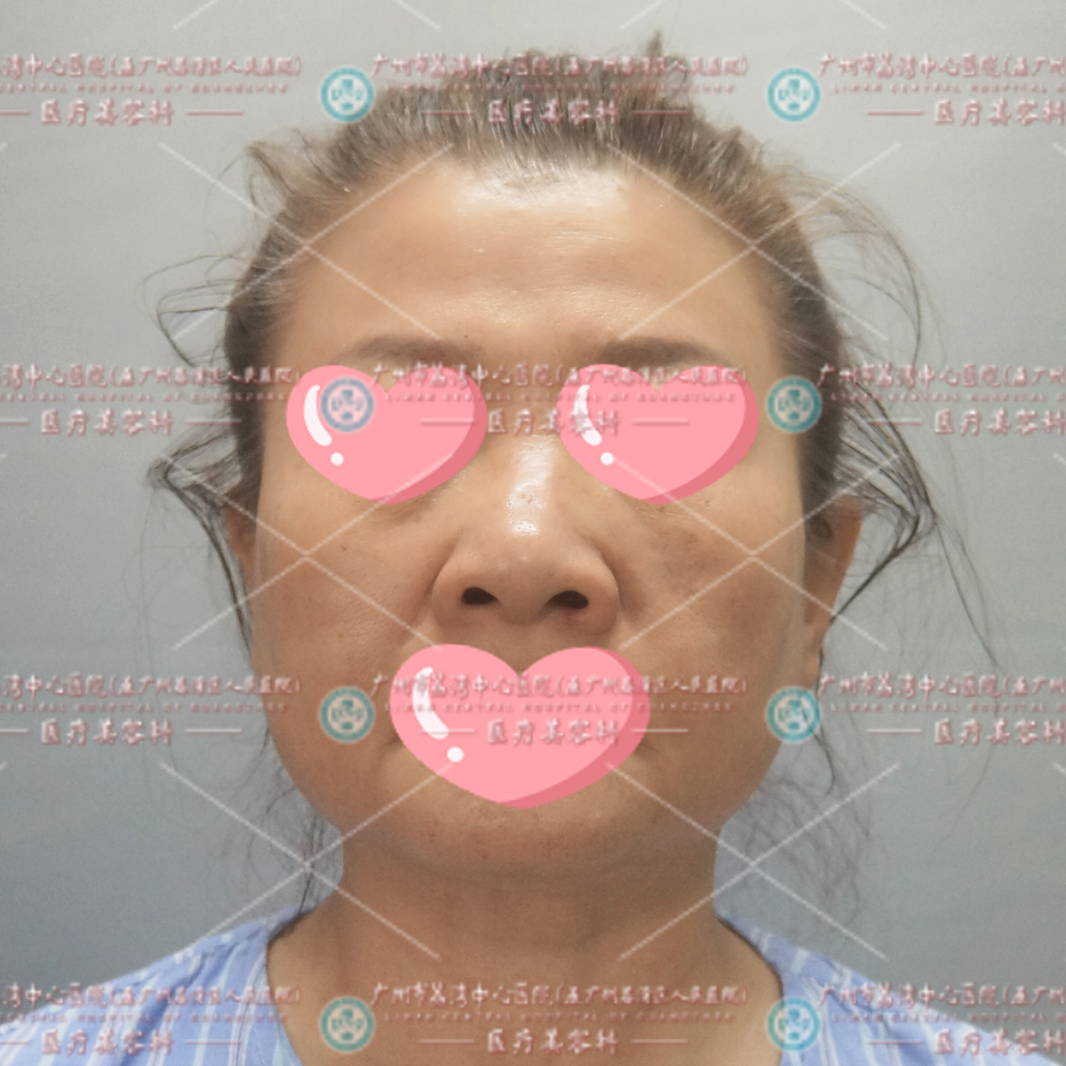 面部打奥美定10多年，游离到额头，肿胀鼓包，来院成功救治