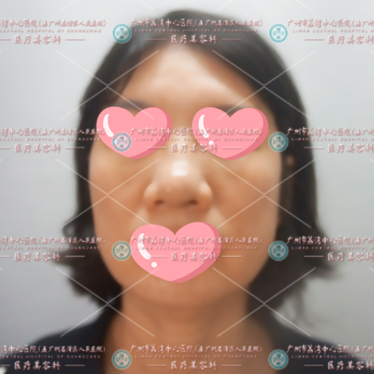 真实故事：奥美定打在脸上22年，两次取出失败，如今面部布满了米粒般的硬块