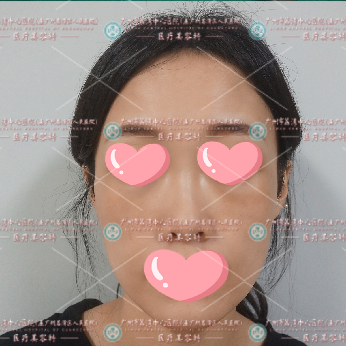 女士注射祛眼袋结果眼周红肿发亮，打溶解酶无效，来我院取出修复