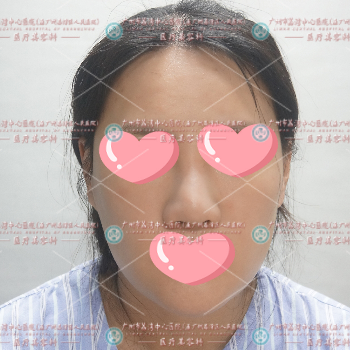 我院上个星期接诊了一位来自浙江的爱美女士。她是和闺蜜结伴在旅游的时候一同在一家整形美容工作室打了"玻尿酸"填充面部，想要改善一下凹陷的问题。  没过两个星期，就发现脸颊两侧出现了硬块结节，触摸手感也很僵硬，导致整个脸看起来假假的，很滑腻不真实，感觉症状不太对劲，怀疑自己被打了假材料。  随即来到我院面诊，经检查后，发现是非法材料奥美定，为她制定了详细的取出和修复方案，并成功地将她面部游离变形的黑美定材料取出，同时进行了必要的组织修复和重建团队，术后，她的面部逐渐恢复了自然和谐的状态。  奥美定是什么？可以注射吗？  奥美定，学名聚丙烯酰胺水凝胶，俗称人造脂肪，是一种无色透明类似果冻状的液态物质，经国家药监局审批，在我国被作为长期植入人体的软组织填充材料，用于注射隆胸、丰颞（太阳穴部位）、隆颊、隆臀等美容术。  奥美定后早期一般没有什么特殊的表现，因为它组织相容性好。很多人刚注射完并不知道自己注射的是奥美定。随着时间的推移，几个月甚至几年后，它会逐渐出现一系列的问题，就是奥美定对组织的侵蚀，造成局部组织的坏死、感染、变形等。  且聚丙烯酰胺水凝胶是一种化学合成物，构成它的单体有剧毒，而化合物无毒性，但注入到人体内后，可能会分解，产生剧毒，毒害神经系统，损伤肾脏，对生命循环系统造成伤害，世界卫生组织已将这种物质列为可疑致癌物之一，是定时危险炸弹。  因此，提醒广告爱美人士，注射整形美容还是要到正规公立医疗机构进行，保护自身健康美丽。