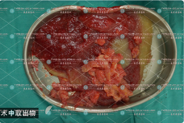 奥美定注射隆胸会危害健康吗？