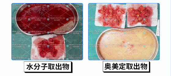 揭秘捷克水分子注射隆胸的危害