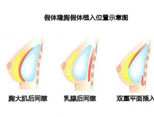 假体隆胸：一位患者的蜕变实录