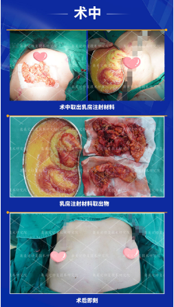 注射了奥美定一定要取出来吗
