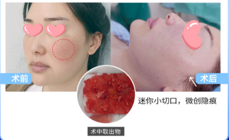 生长因子馒化脸怎么解决