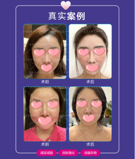 脸部馒化怎么修复？