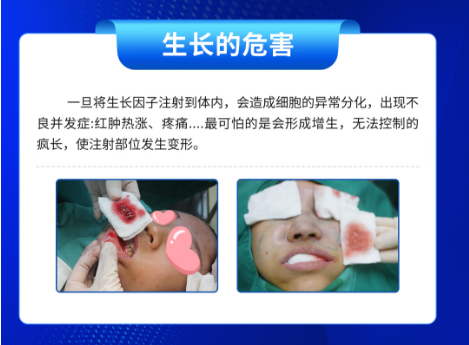 从"蛇精下巴"到自然美：一场失控的生长因子冒险