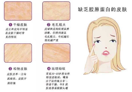 胶原蛋白和玻尿酸哪个填充效果好