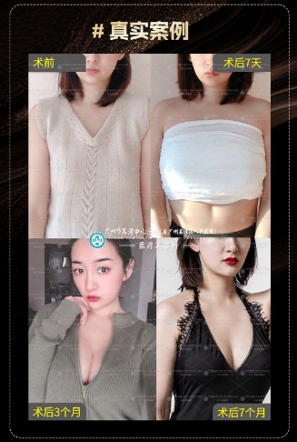 隆胸假体不取出会有什么影响