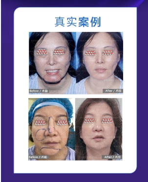 馒化和正常脸的区别