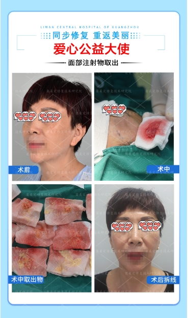 生长因子填充面部多久会疯长