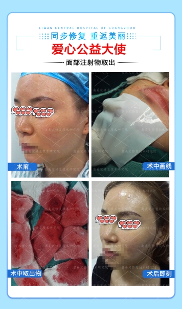 生长因子会在什么情况下刺激组织疯长