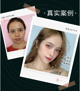 假体隆鼻取出后鼻子会变得更塌吗