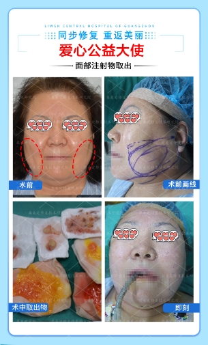 下巴取生长因子通过什么方法取出来？