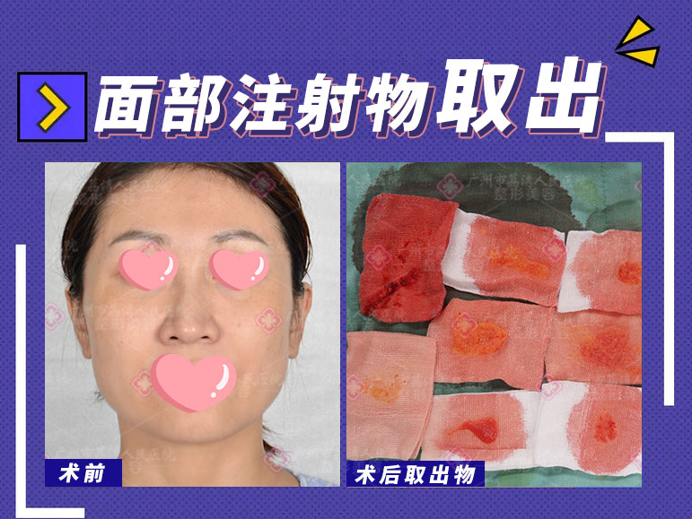 脸部被注射了奥美定应该怎么办？奥美定有哪些并发症呢？