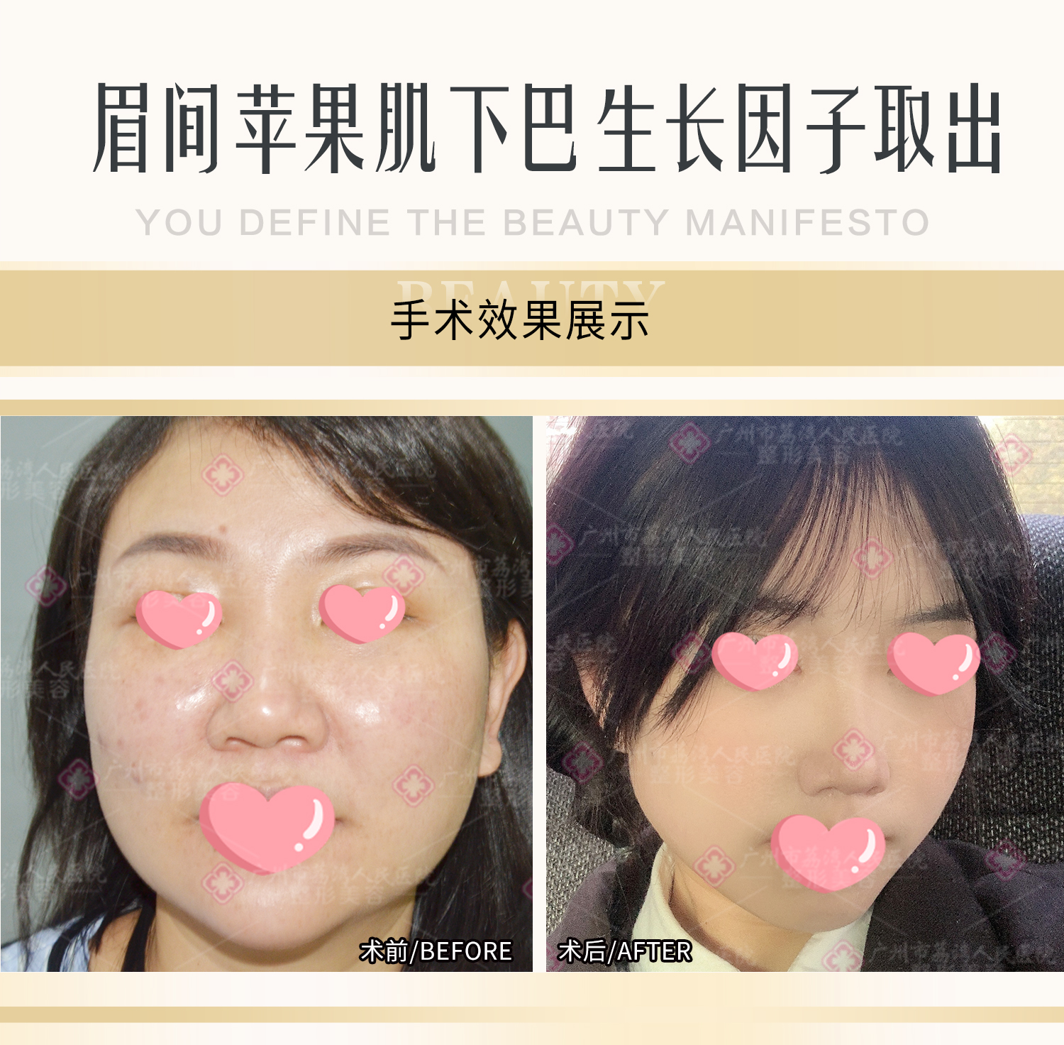 生长因子填充面部多久会疯长？