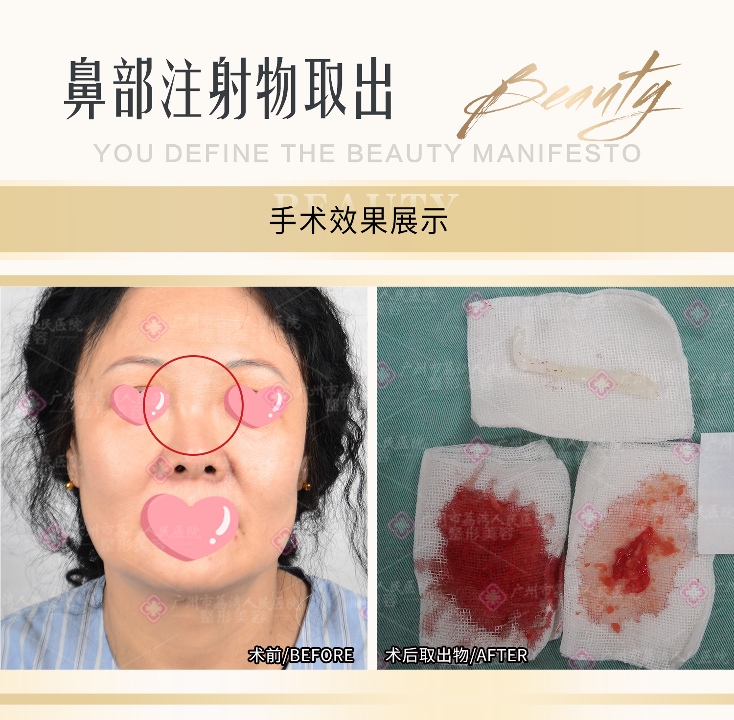 填充了骨粉隆鼻可以不取出吗？