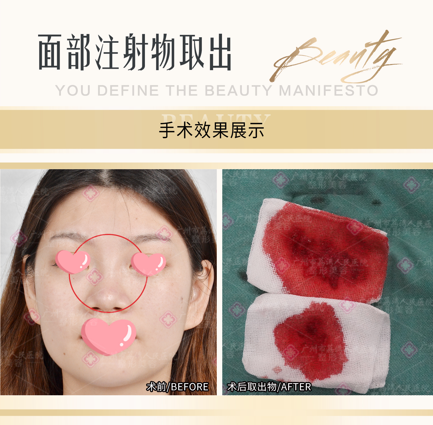 打了假的玻尿酸会怎样？