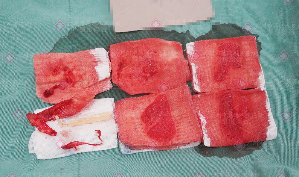 捷克水分子丰体针隆胸有什么危害？