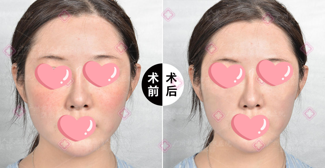 奥美定出现症状的概率有多大？