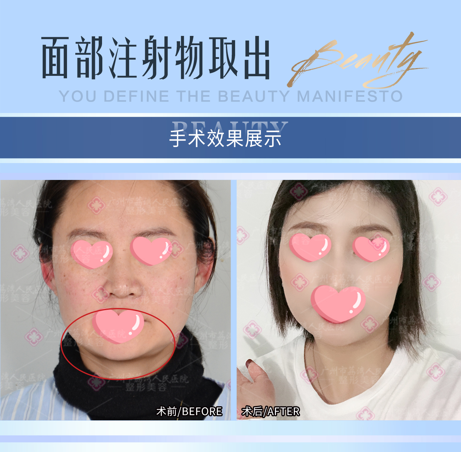 打了假的玻尿酸会怎么样？