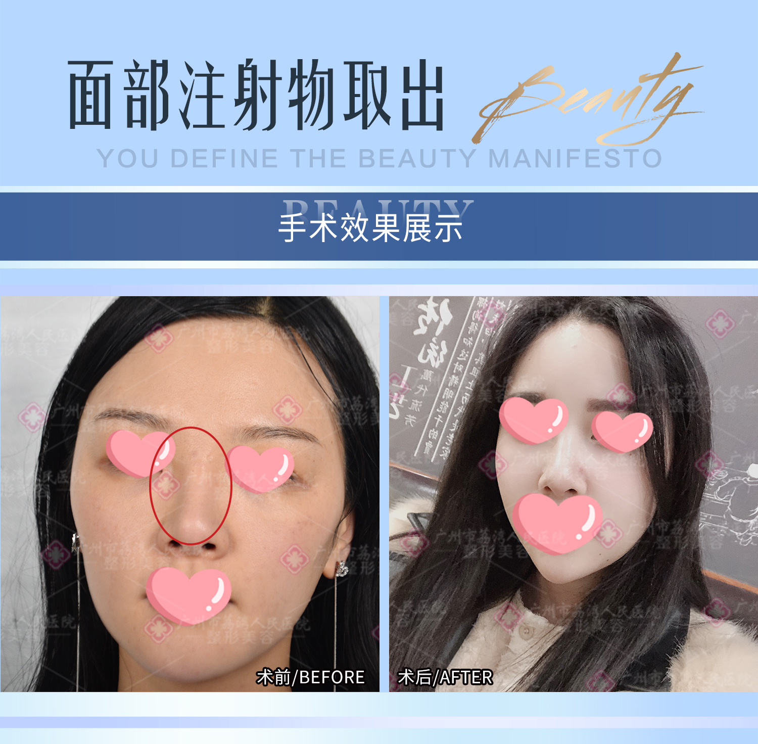 取出面部奥美定要多少钱？