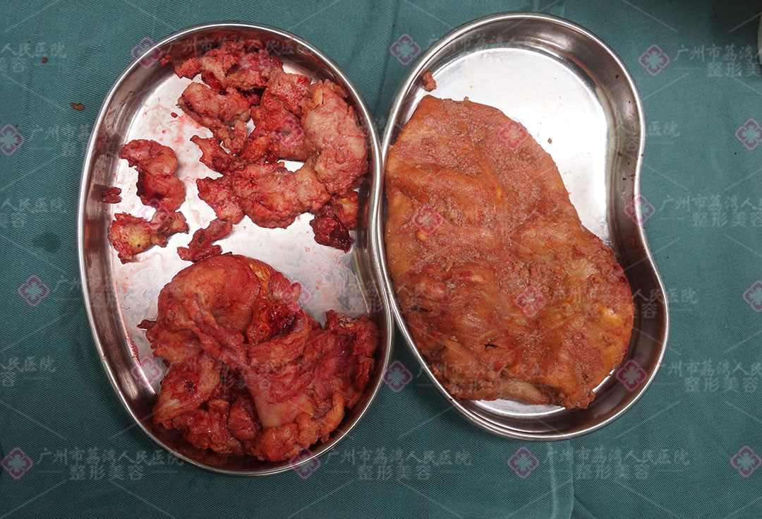 注射水分子丰体针隆胸的症状和奥美定很像吗？