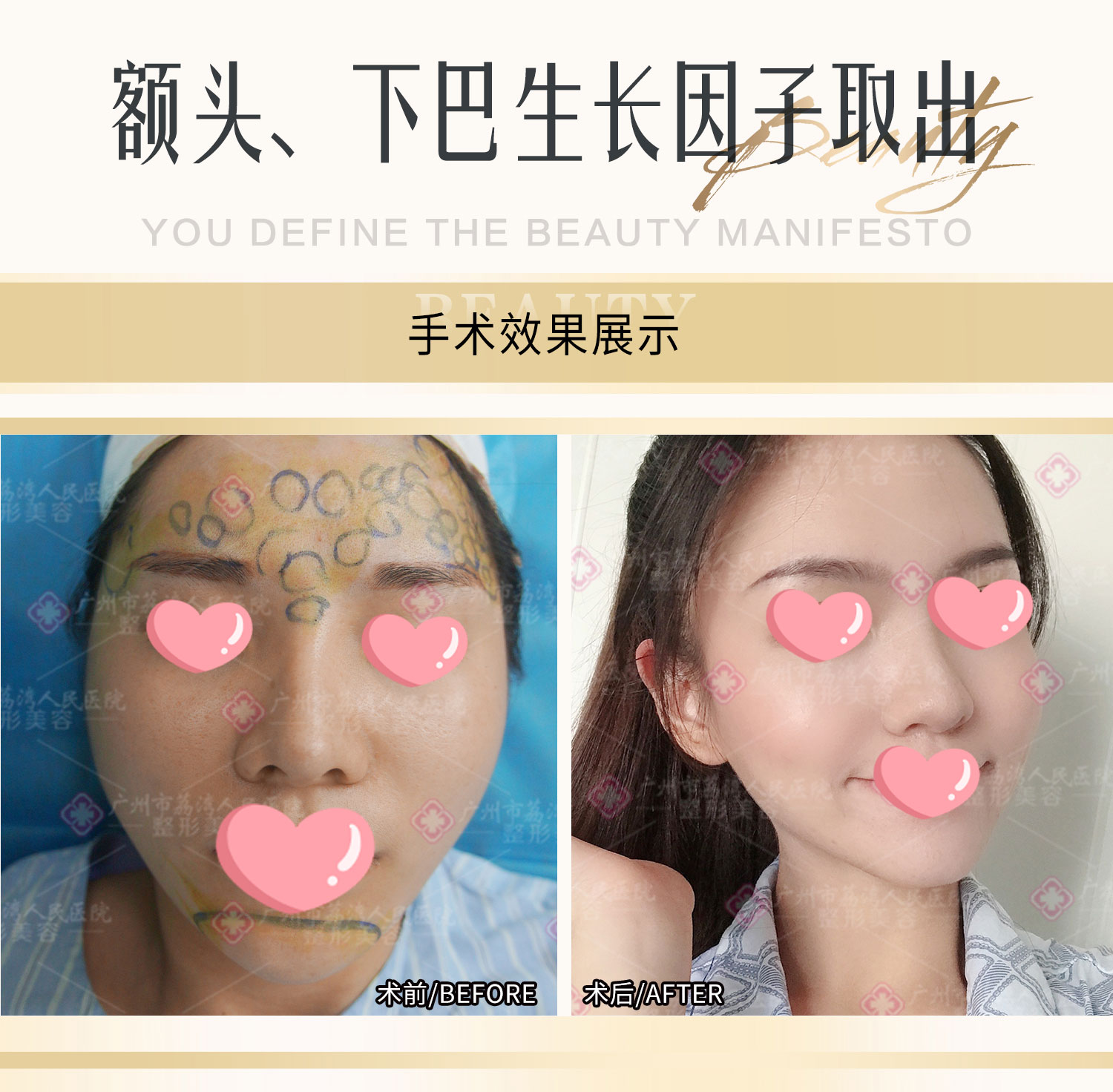 注射生长因子可以代谢吗？