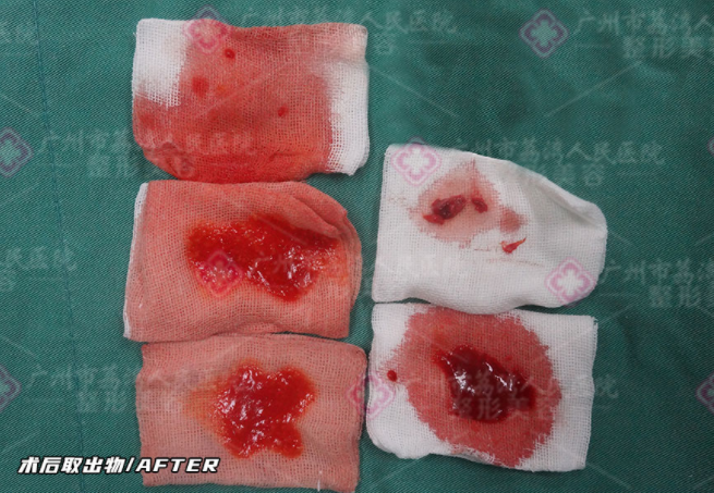 水分子丰体针安全吗？