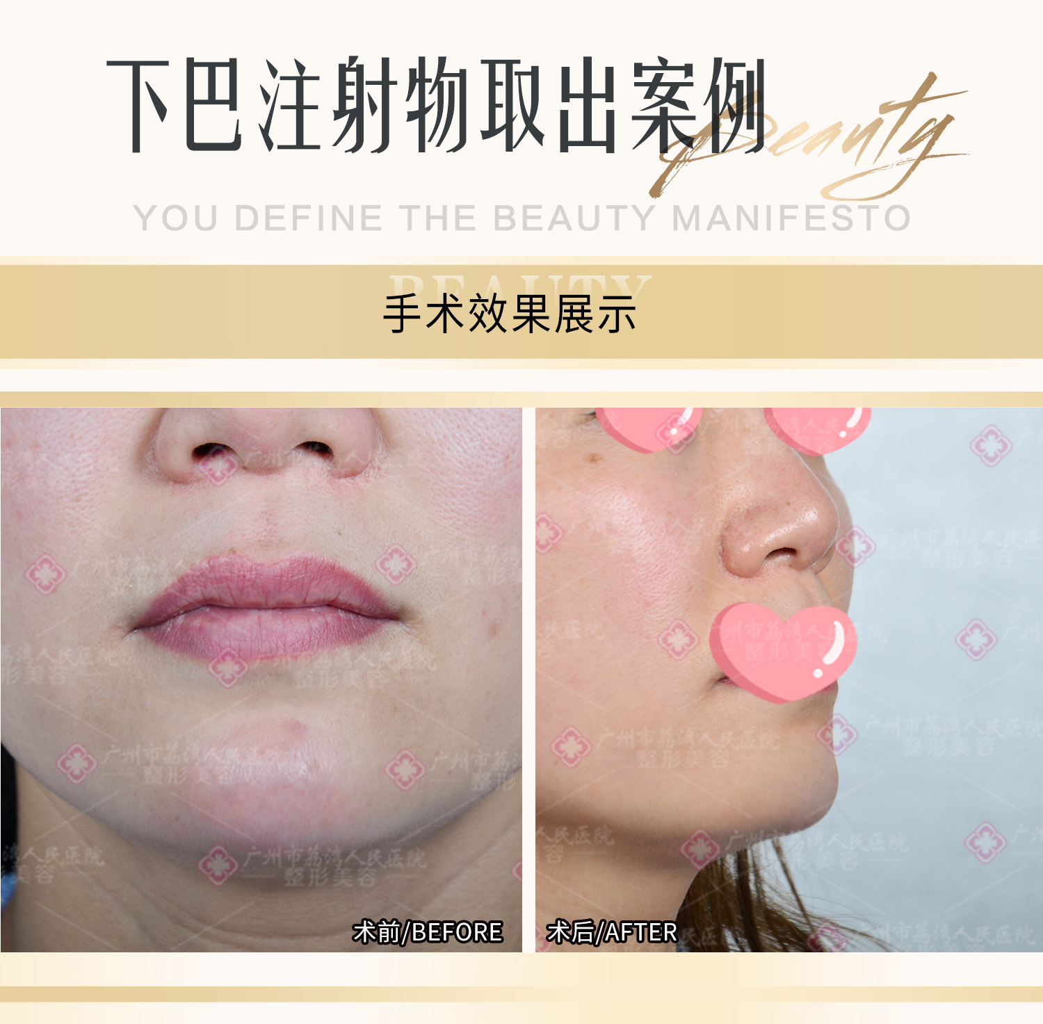 取出生长因子哪家医院好？